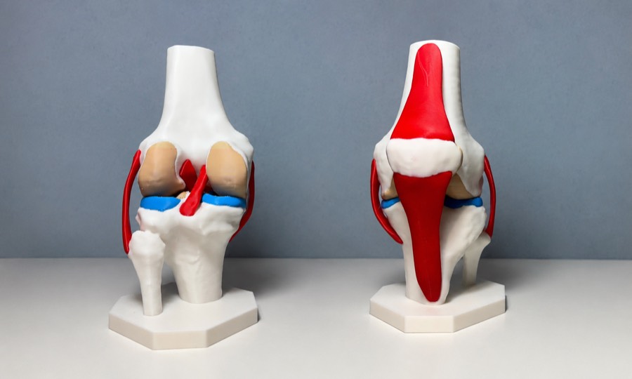 Dos modelos de rodilla impresos en 3D, vista anterior y posterior, con ligamentos en rojo y meniscos en azul